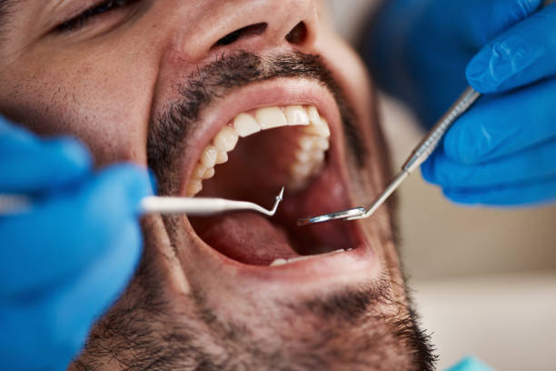 Best Emergency Dental Care for Broken or Chipped Teeth in Indianola, WA