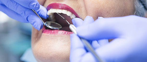 Best Emergency Dental Care for Broken or Chipped Teeth in Indianola, WA